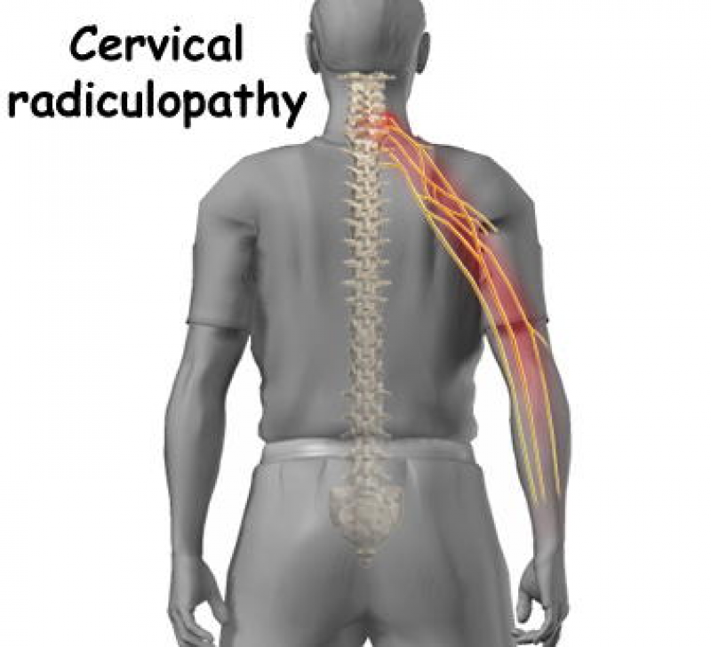 Cervical Radiculopathy Anatomy